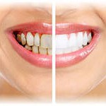 Реставрация зубов от белых пятен