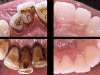 ультразвуковая чистка зубов фото до и после