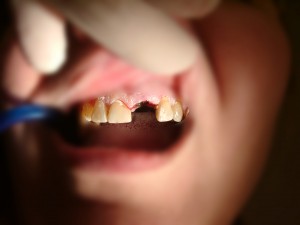 адгезивный протез 2 выполнен в стоматологии Рико